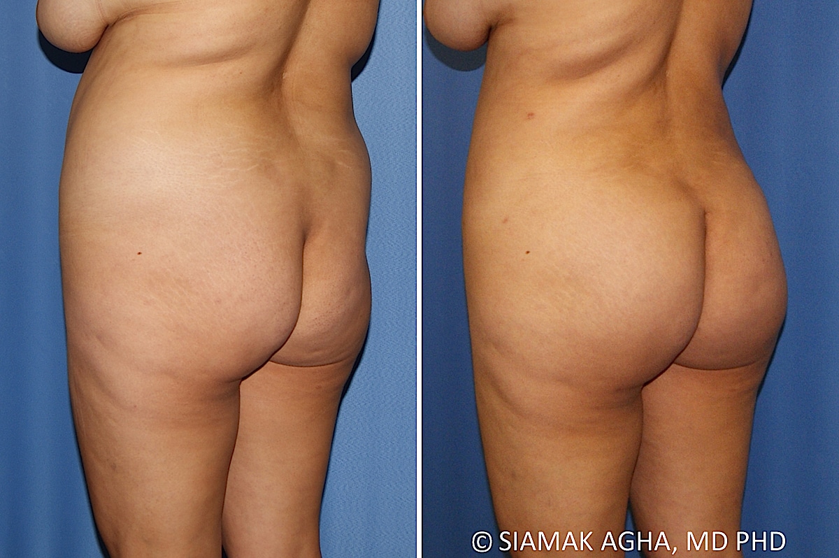 orange county brazilian butt lift patient 33 back left Newport Beach, CA