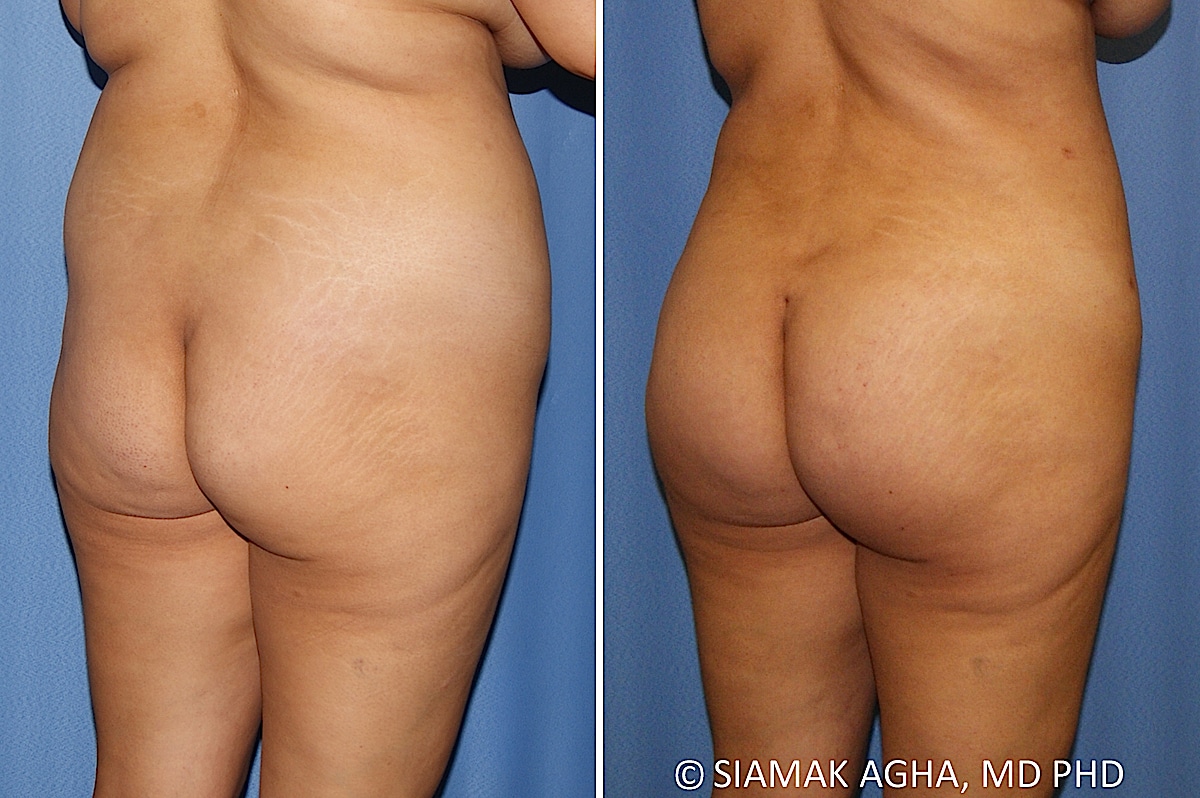 orange county brazilian butt lift patient 33 back right Newport Beach, CA