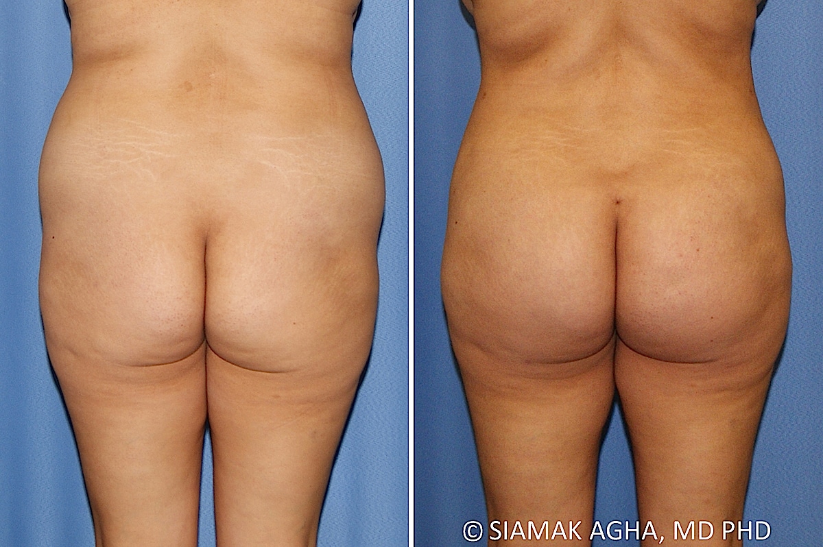 Orange County Brazilian Butt Lift Patient 33 Back Newport Beach, CA