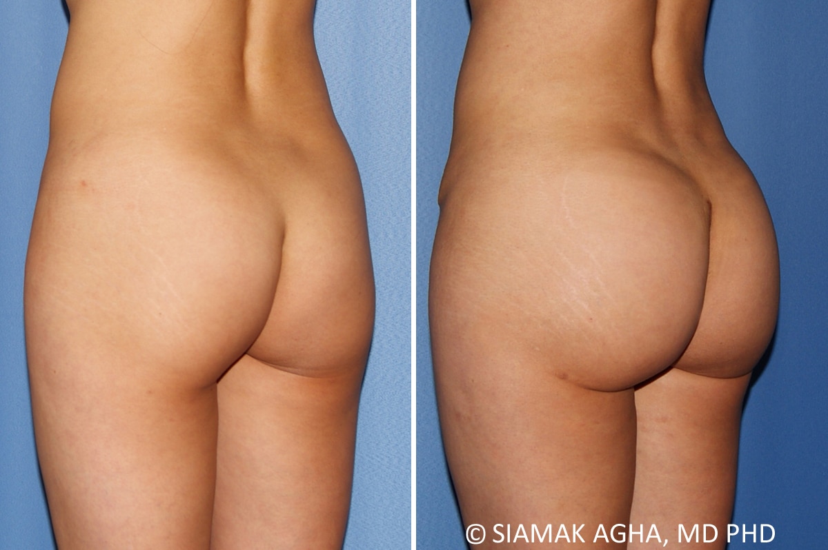 Orange County Brazilian Butt Lift Patient 34 Back Left Newport Beach, CA