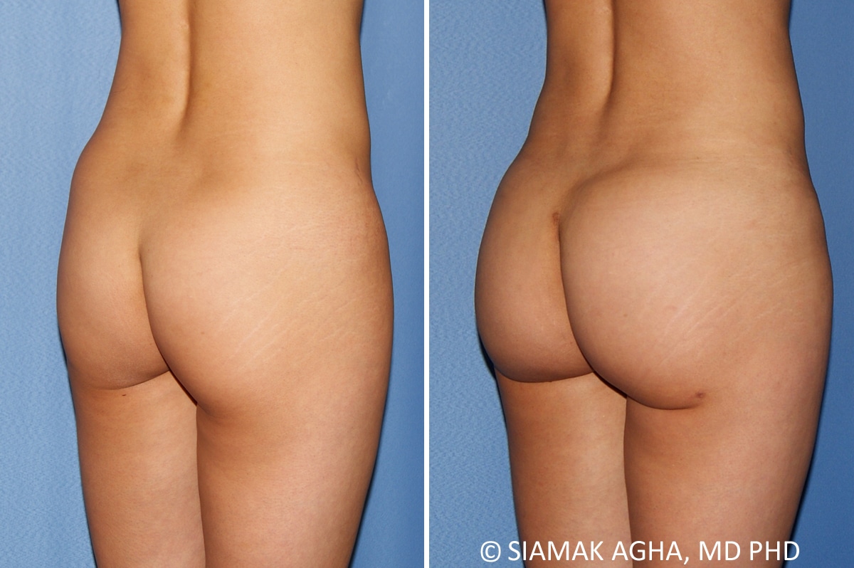 Orange County Brazilian Butt Lift Patient 34 Back Right Newport Beach, CA