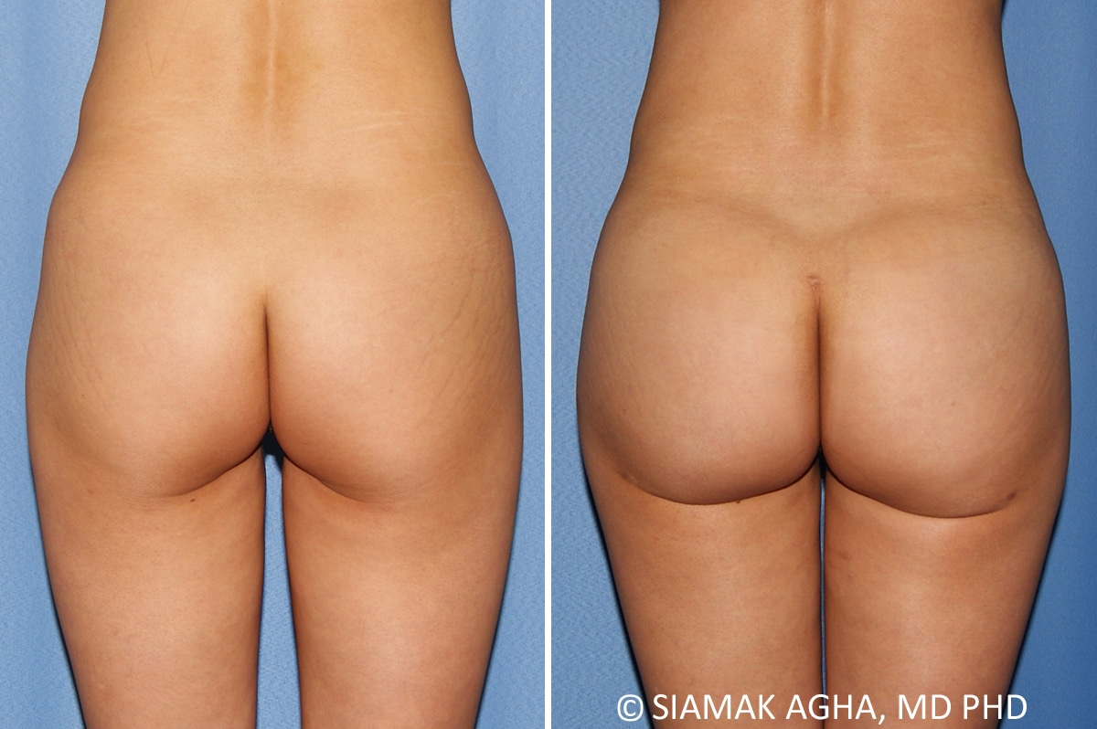 orange county brazilian butt lift patient 34 back Newport Beach, CA