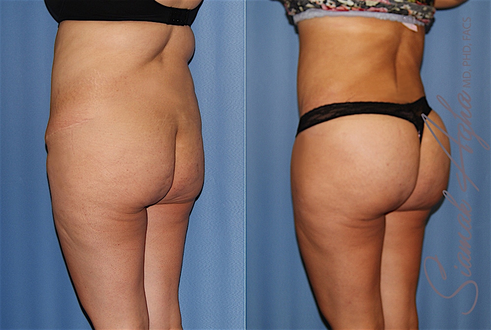 orange county brazilian butt lift patient 35 back left Newport Beach, CA