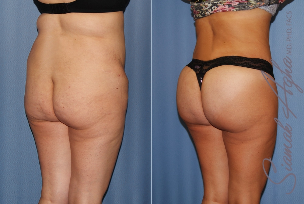 Orange County Brazilian Butt Lift Patient 35 Back Right Newport Beach, CA