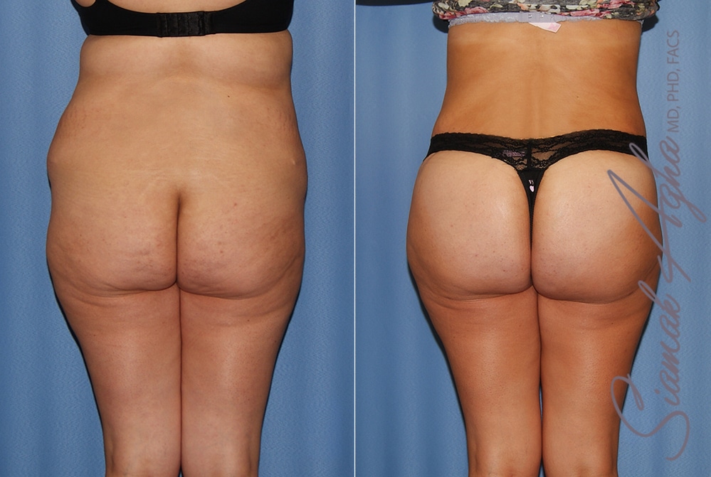 orange county brazilian butt lift patient 35 back Newport Beach, CA