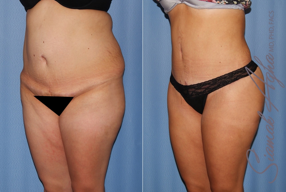 orange county brazilian butt lift patient 35 front left Newport Beach, CA