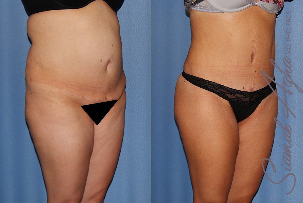 Orange County Brazilian Butt Lift Patient 35 Front Right Newport Beach, CA