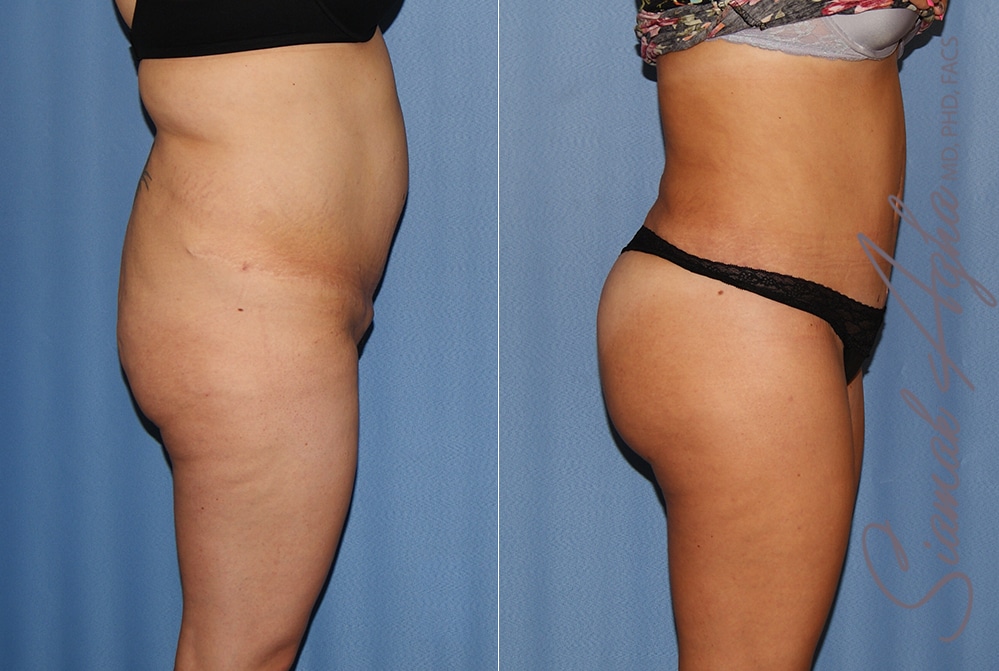 Orange County Brazilian Butt Lift Patient 35 Right Newport Beach, CA