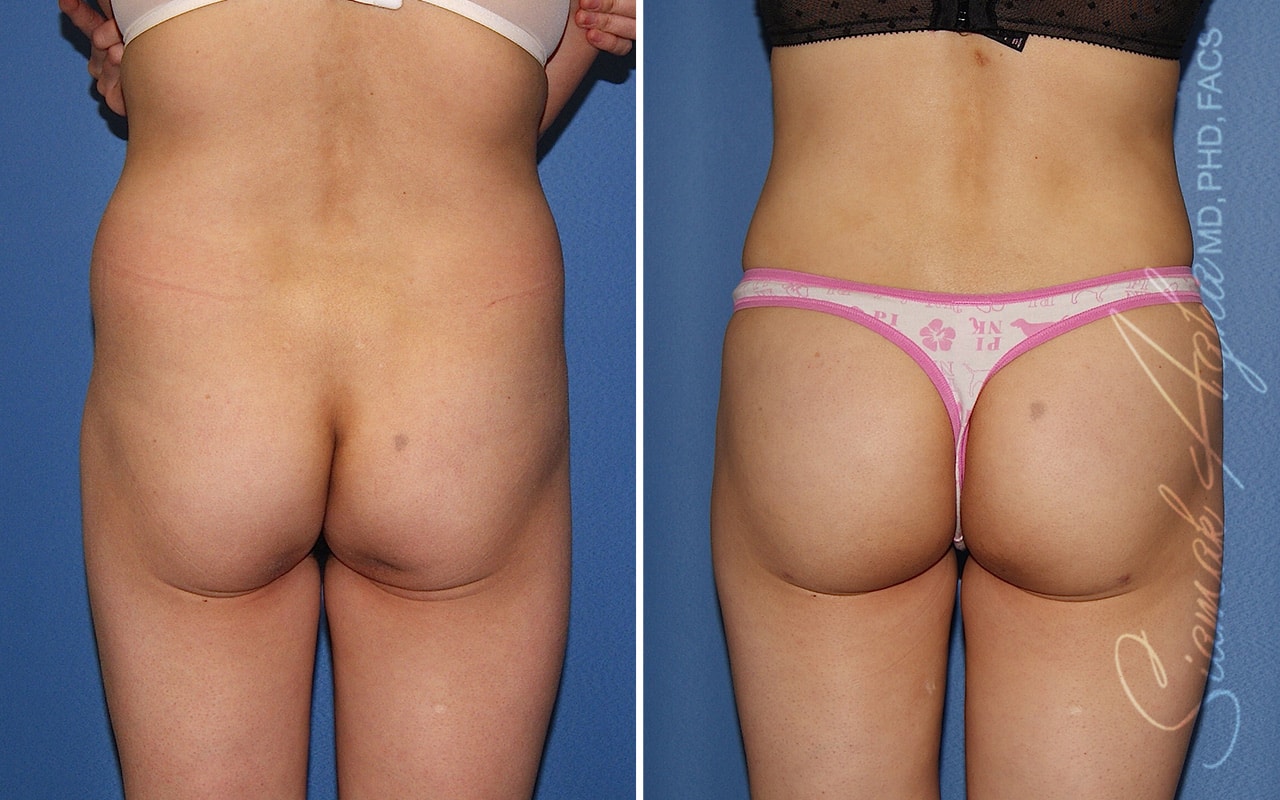 Orange County Brazilian Butt Lift Patient 36 Back Newport Beach, CA