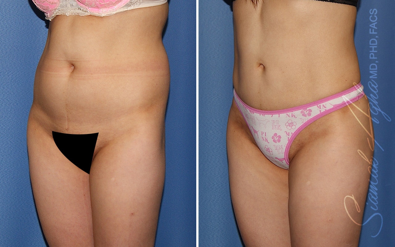 orange county brazilian butt lift patient 36 front left Newport Beach, CA