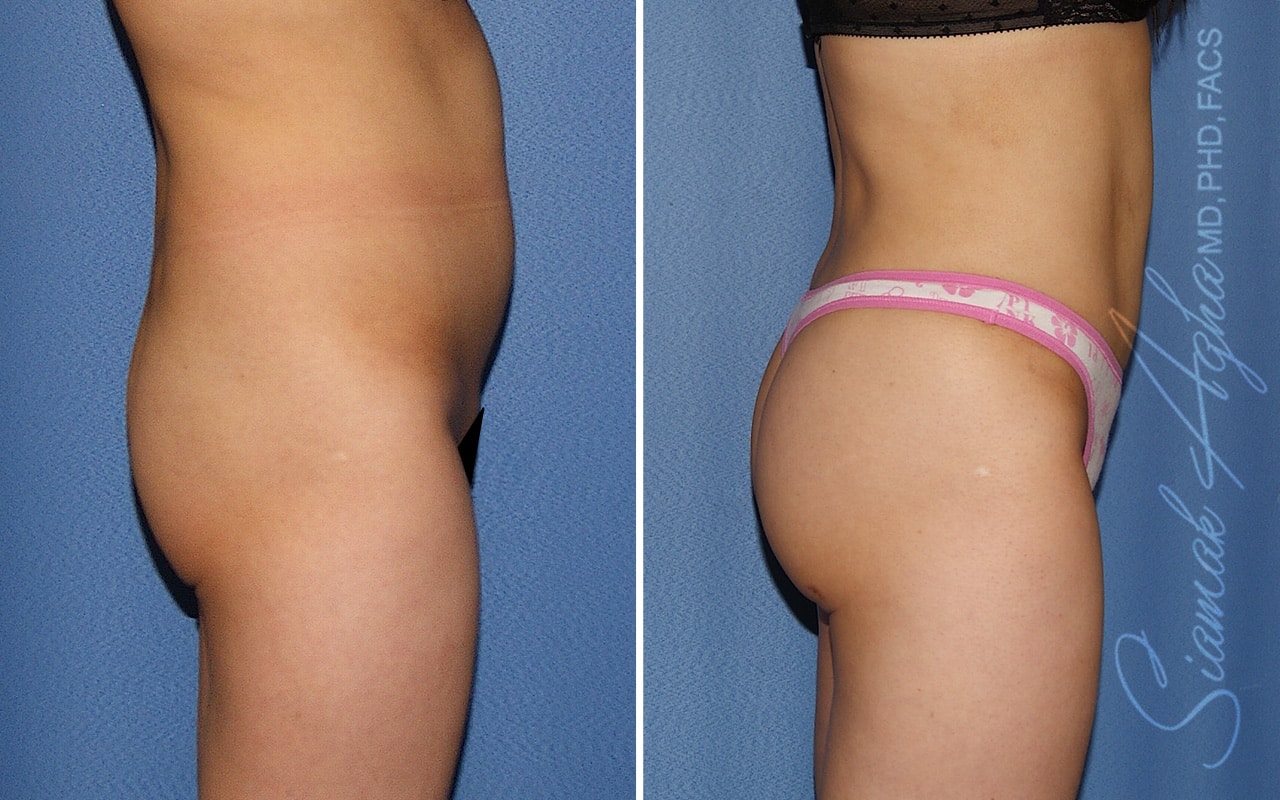 Orange County Brazilian Butt Lift Patient 36 Right Newport Beach, CA