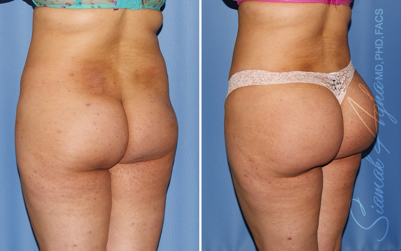 Orange County Brazilian Butt Lift Patient 37 Back Left Newport Beach, CA