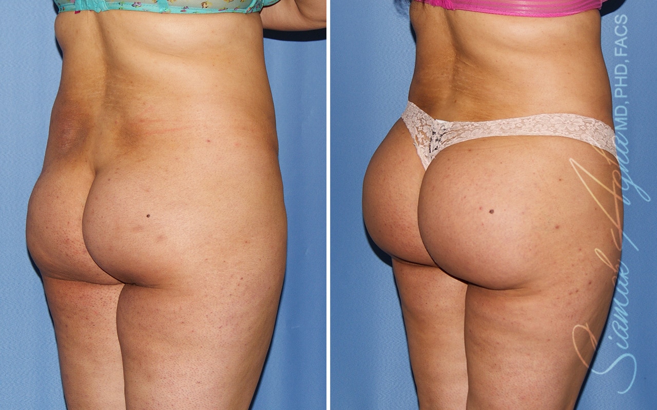 orange county brazilian butt lift patient 37 back right Newport Beach, CA