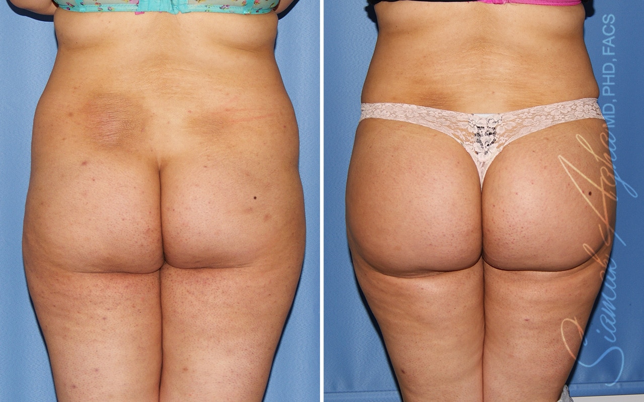 Orange County Brazilian Butt Lift Patient 37 Back Newport Beach, CA