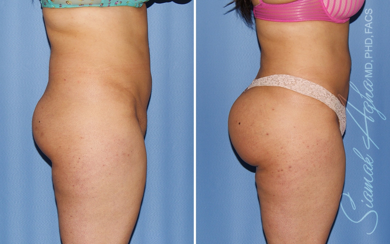 orange county brazilian butt lift patient 37 right Newport Beach, CA