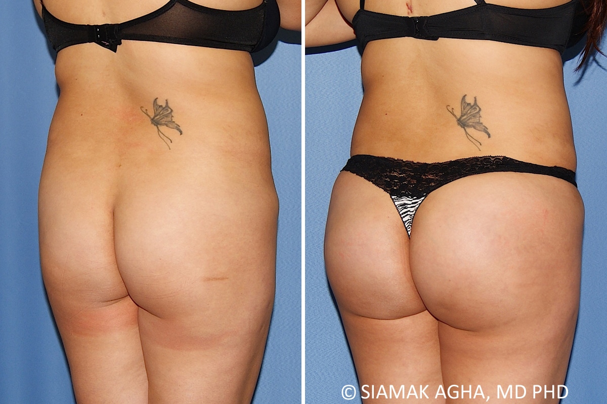 Orange County Brazilian Butt Lift Patient 38 Back Right Newport Beach, CA