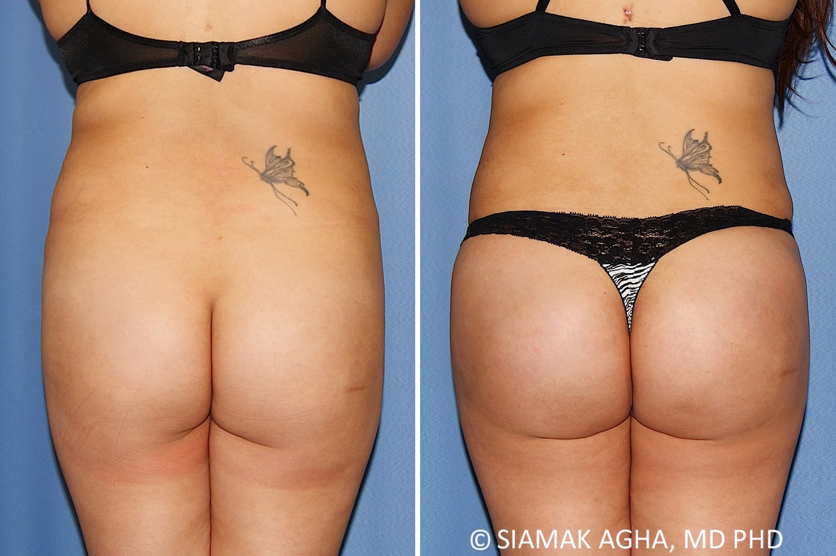 Orange County Brazilian Butt Lift Patient 38 Back Newport Beach, CA