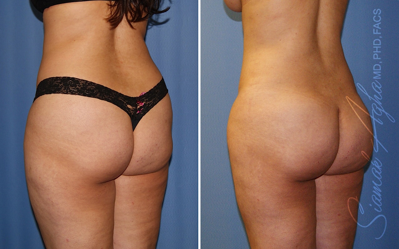 Orange County Brazilian Butt Lift Patient 39 Back Left Newport Beach, CA