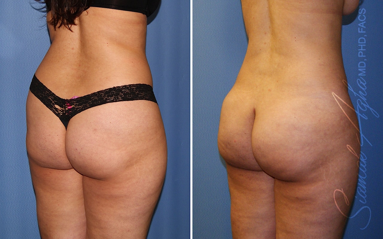 Orange County Brazilian Butt Lift Patient 39 Back Right Newport Beach, CA