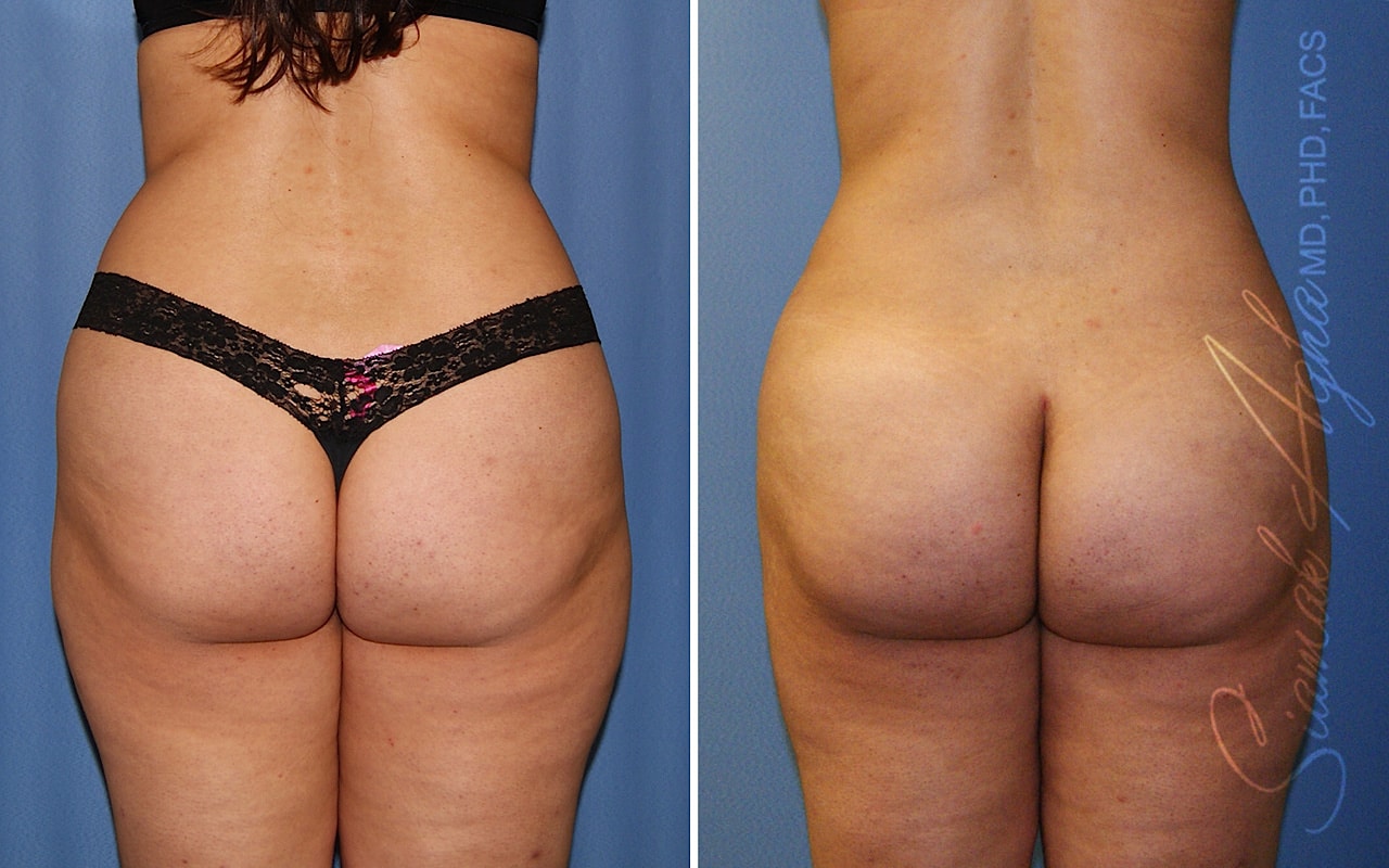 Orange County Brazilian Butt Lift Patient 39 Back Newport Beach, CA