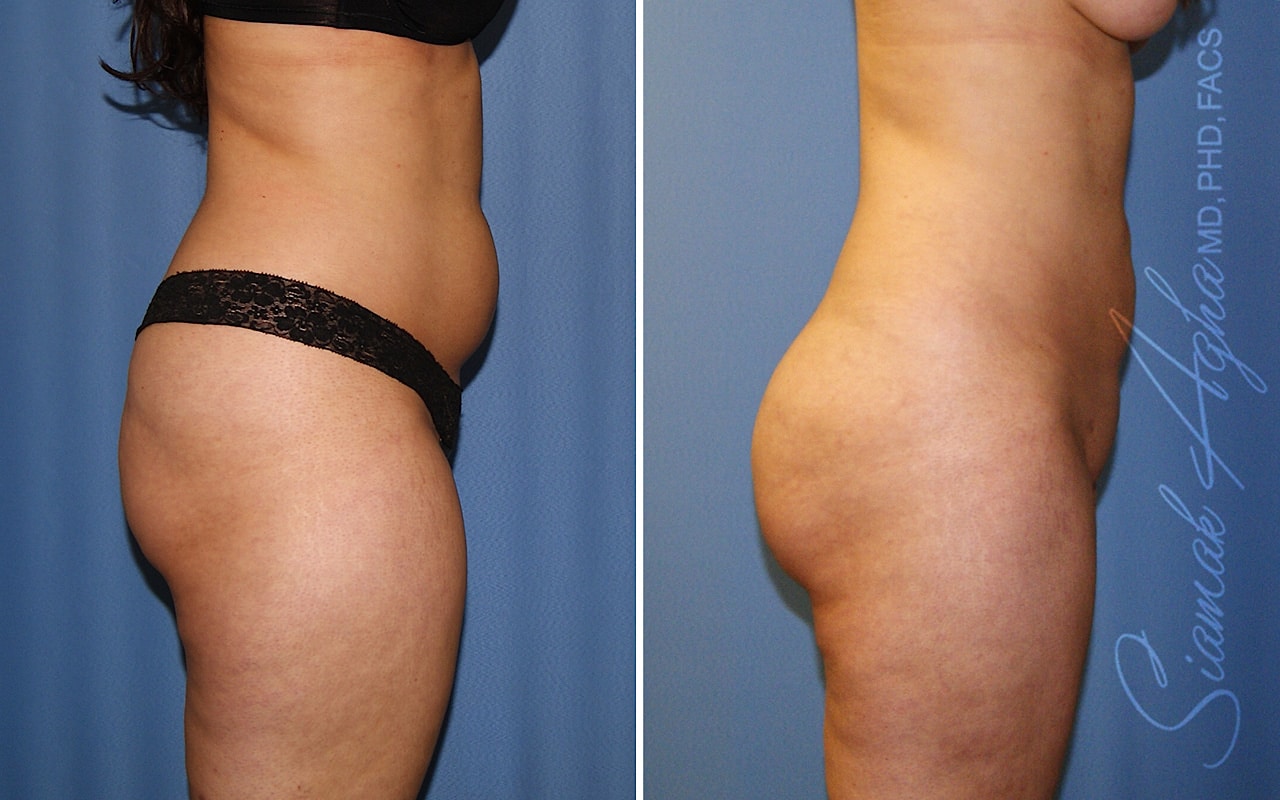 orange county brazilian butt lift patient 39 right Newport Beach, CA