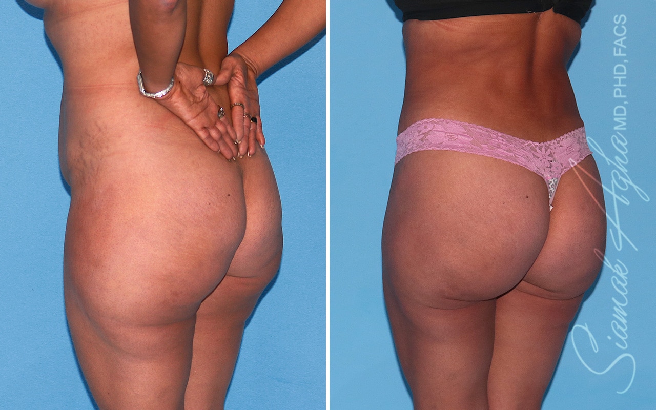 Orange County Brazilian Butt Lift Patient 43 Back Left Newport Beach, CA