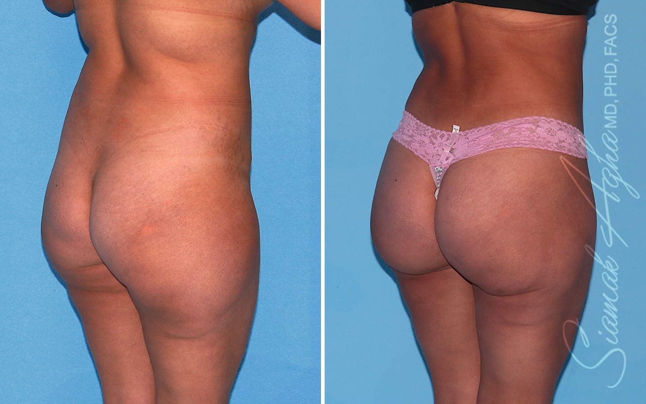 Orange County Brazilian Butt Lift Patient 43 Back Right Newport Beach, CA