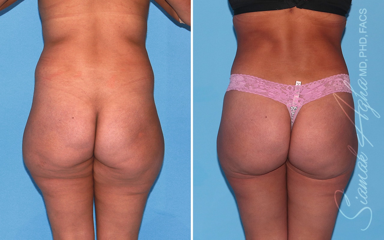 Orange County Brazilian Butt Lift Patient 43 Back Newport Beach, CA