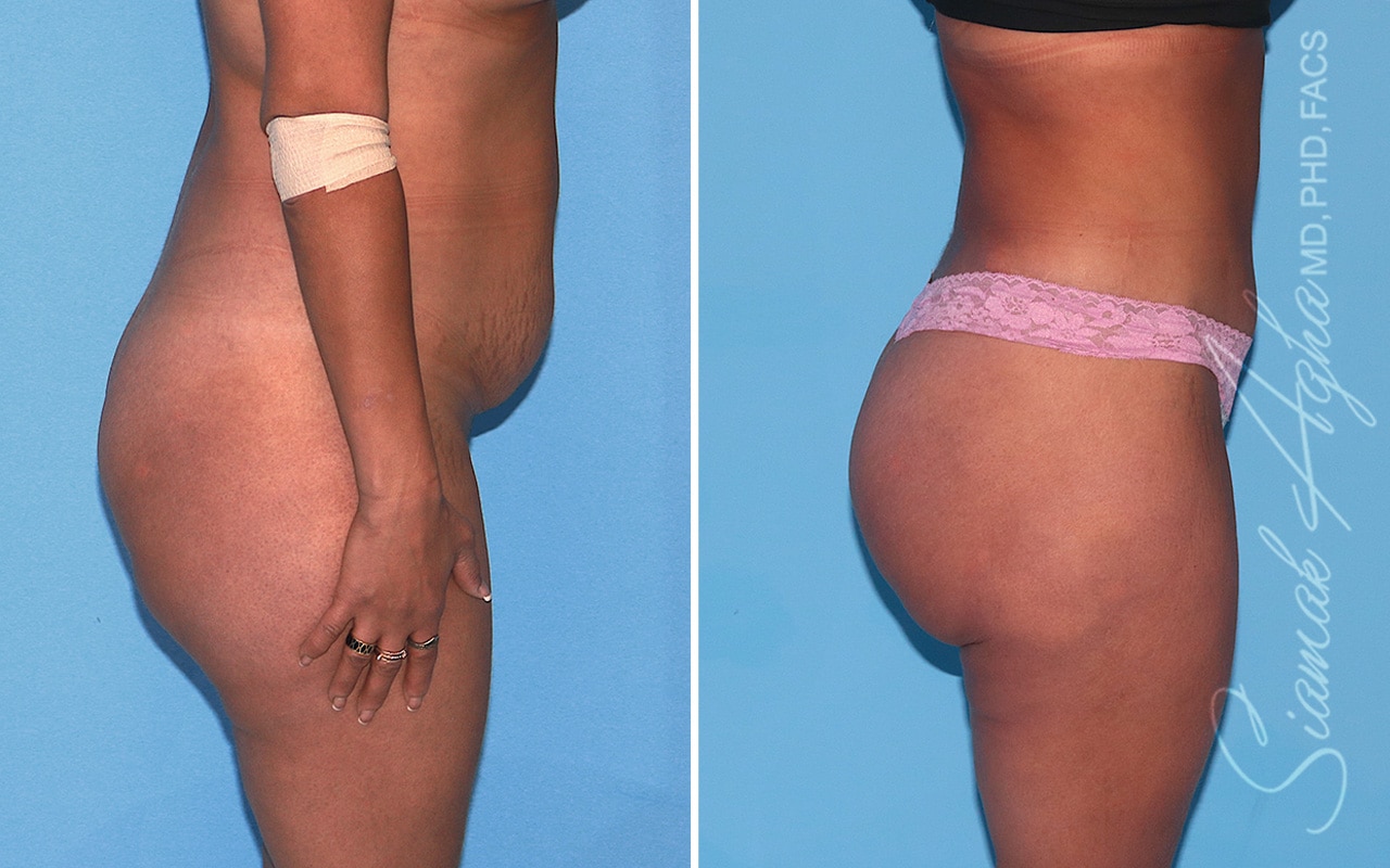 orange county brazilian butt lift patient 43 right Newport Beach, CA