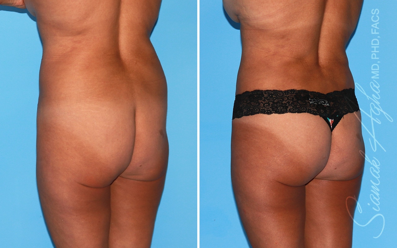 Orange County Brazilian Butt Lift Patient 44 Back Left Newport Beach, CA