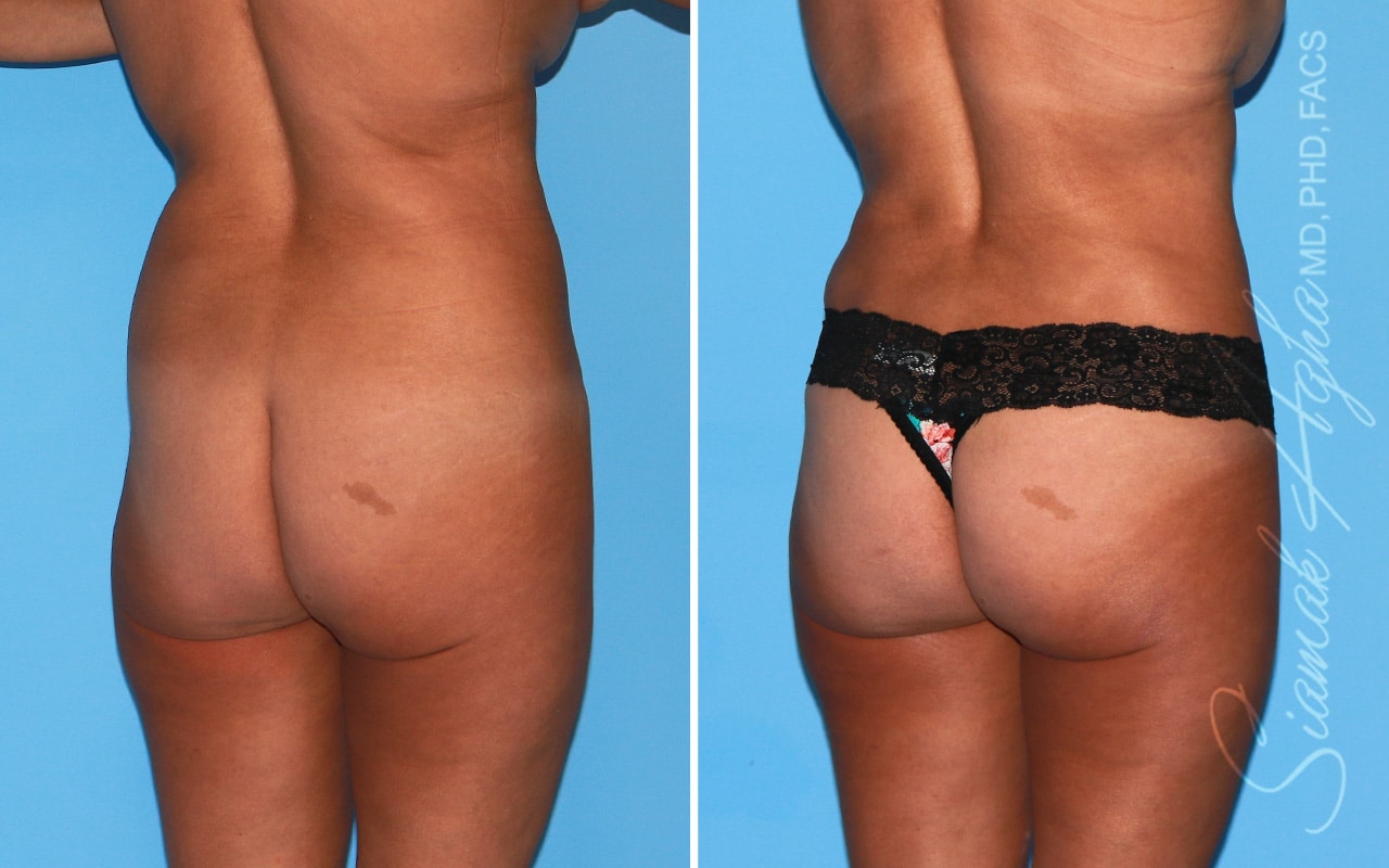 Orange County Brazilian Butt Lift Patient 44 Back Right Newport Beach, CA