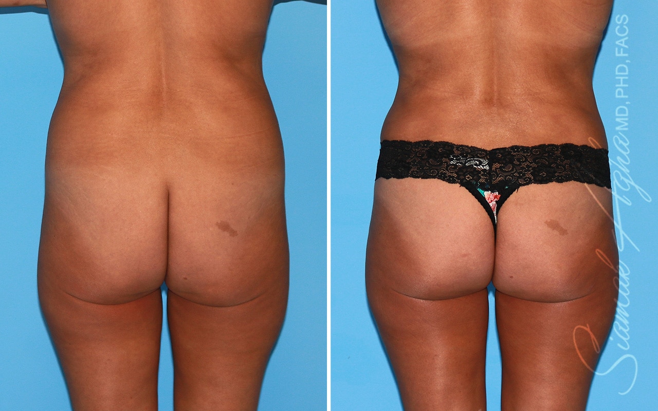 Orange County Brazilian Butt Lift Patient 44 Back Newport Beach, CA