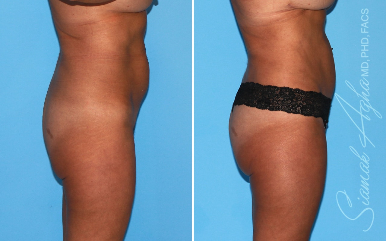 Orange County Brazilian Butt Lift Patient 44 Right Newport Beach, CA