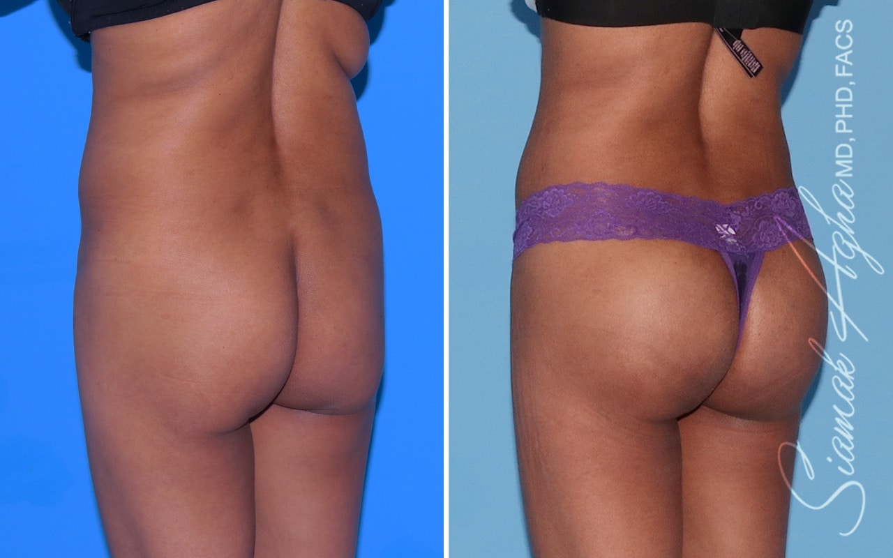 Orange County Brazilian Butt Lift Patient 46 Back Left Newport Beach, CA