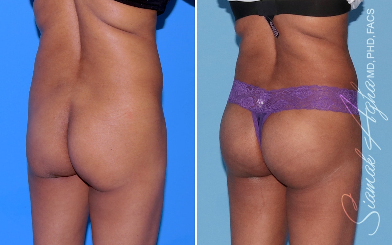 Orange County Brazilian Butt Lift Patient 46 Back Right Newport Beach, CA