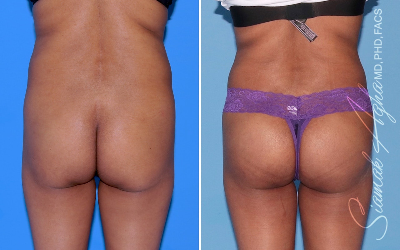 Orange County Brazilian Butt Lift Patient 46 Back Newport Beach, CA