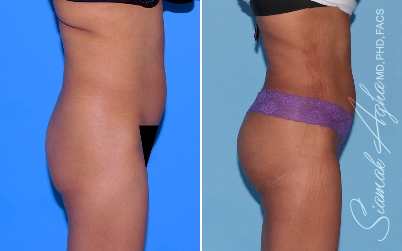 Orange County Brazilian Butt Lift Patient 46 Right Newport Beach, CA