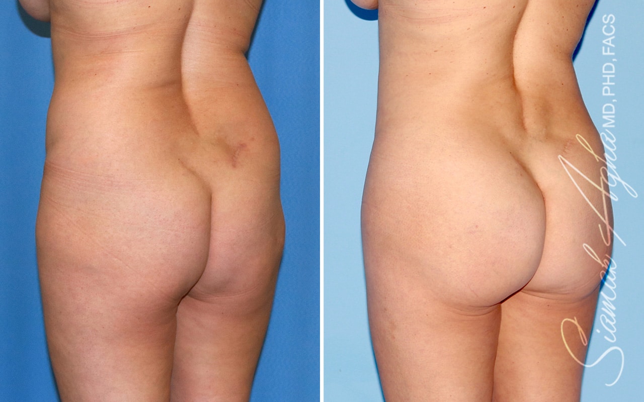 orange county brazilian butt lift patient 48 back left Newport Beach, CA