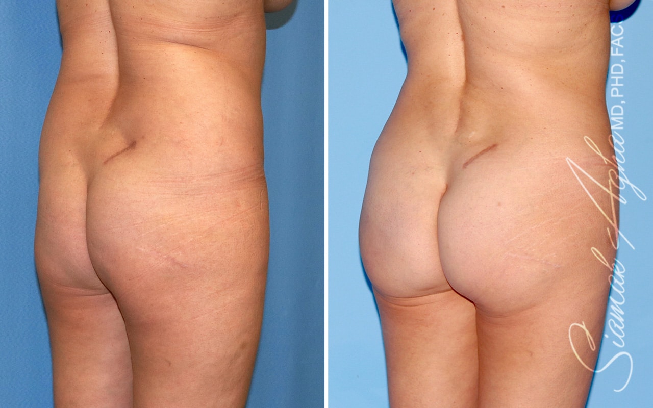 orange county brazilian butt lift patient 48 back right Newport Beach, CA