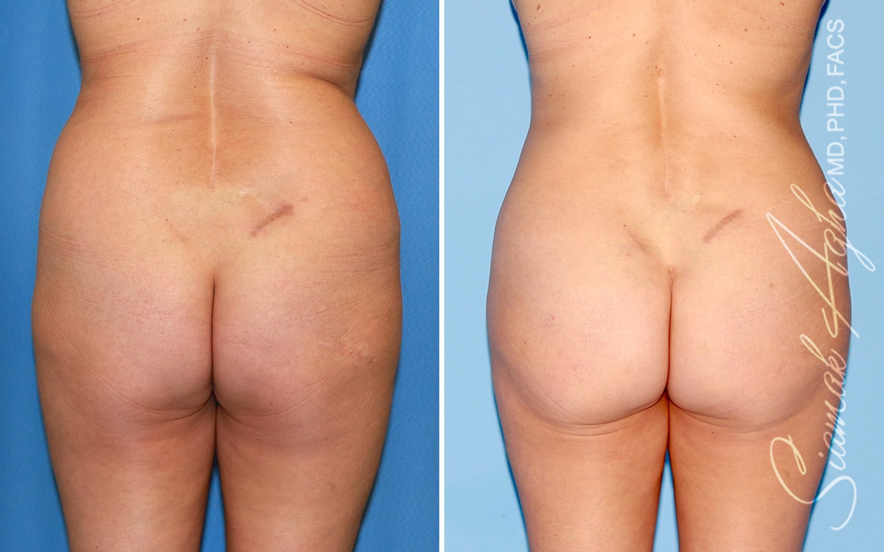 orange county brazilian butt lift patient 48 back Newport Beach, CA