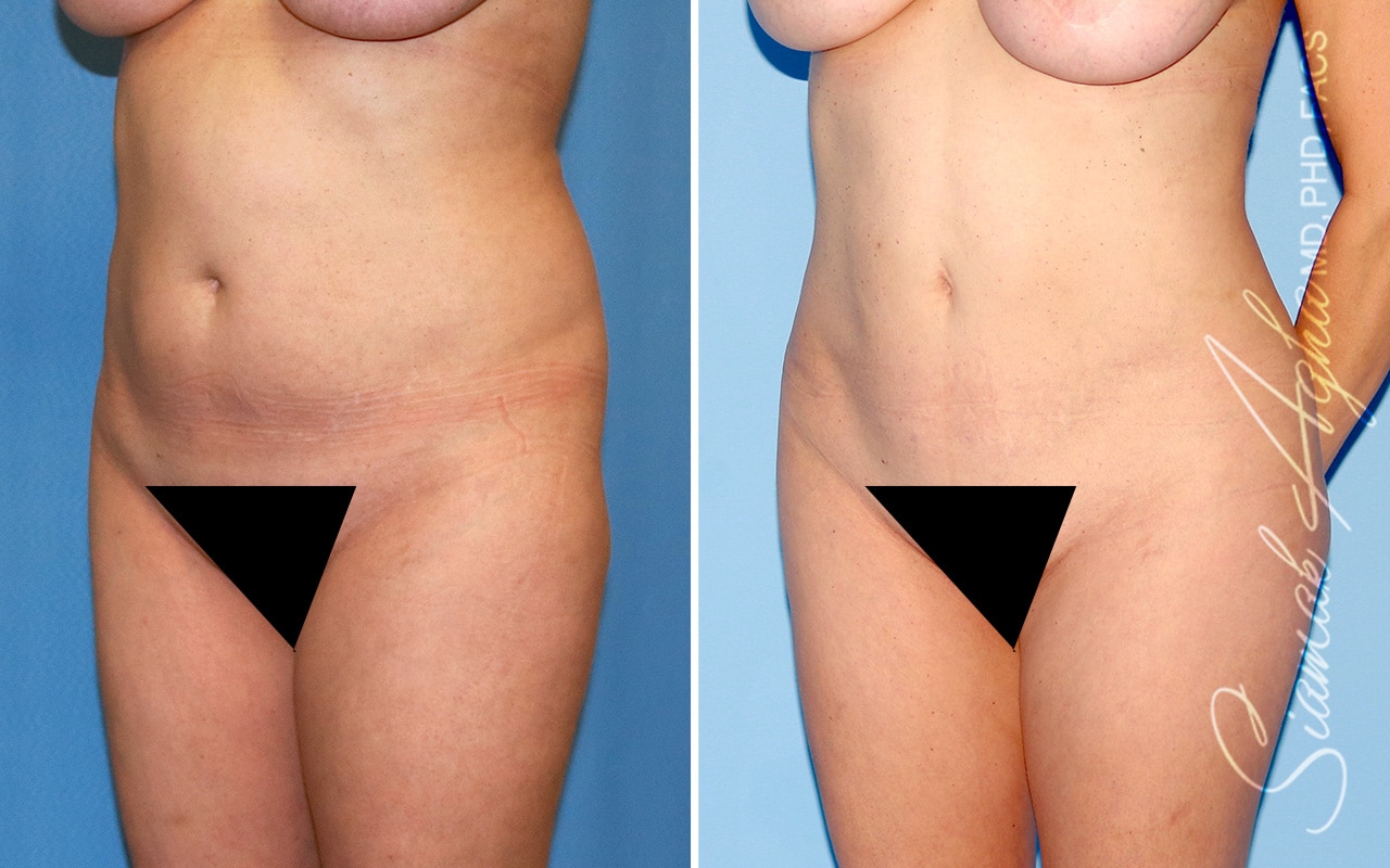 orange county brazilian butt lift patient 48 front left Newport Beach, CA