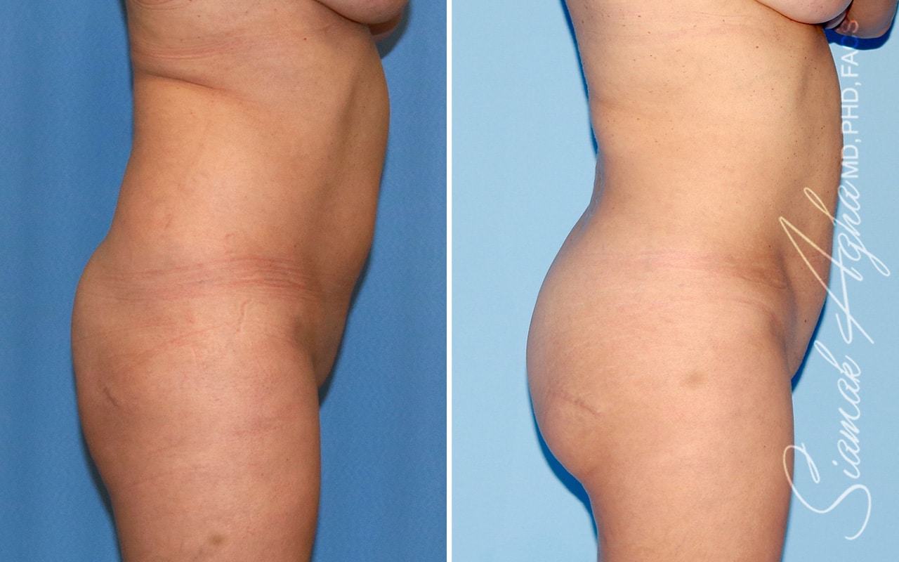 Orange County Brazilian Butt Lift Patient 48 Right Newport Beach, CA