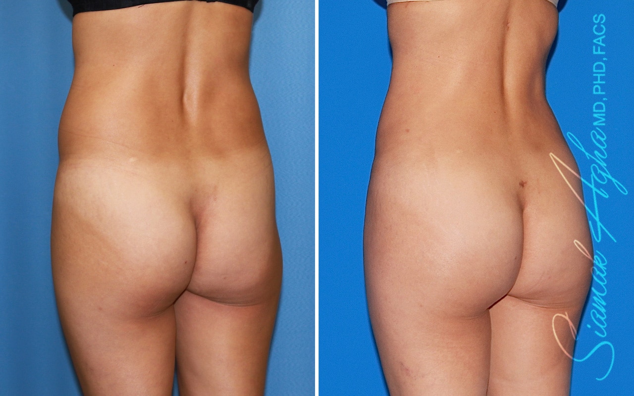 orange county brazilian butt lift patient 49 back left Newport Beach, CA