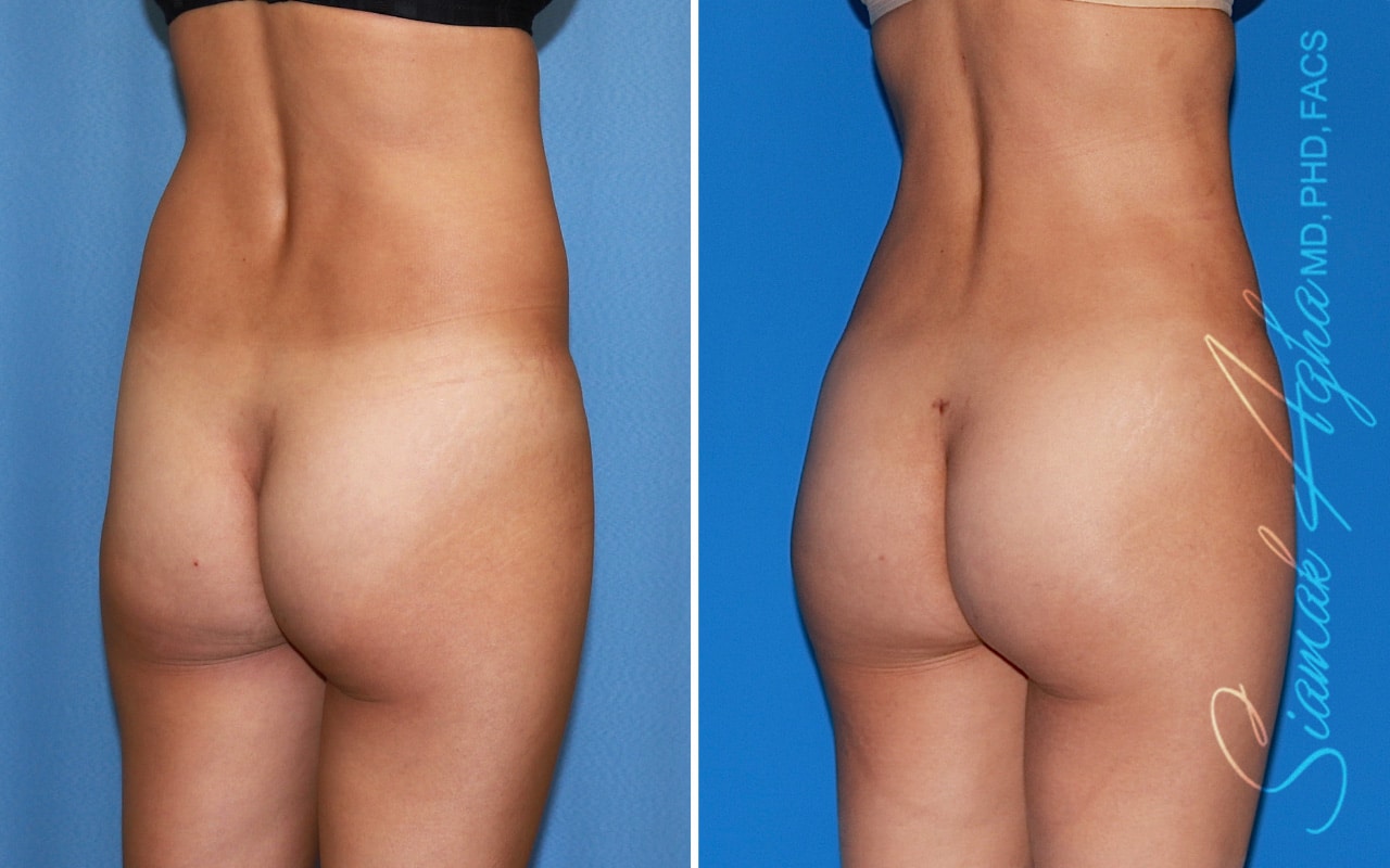 orange county brazilian butt lift patient 49 back right Newport Beach, CA