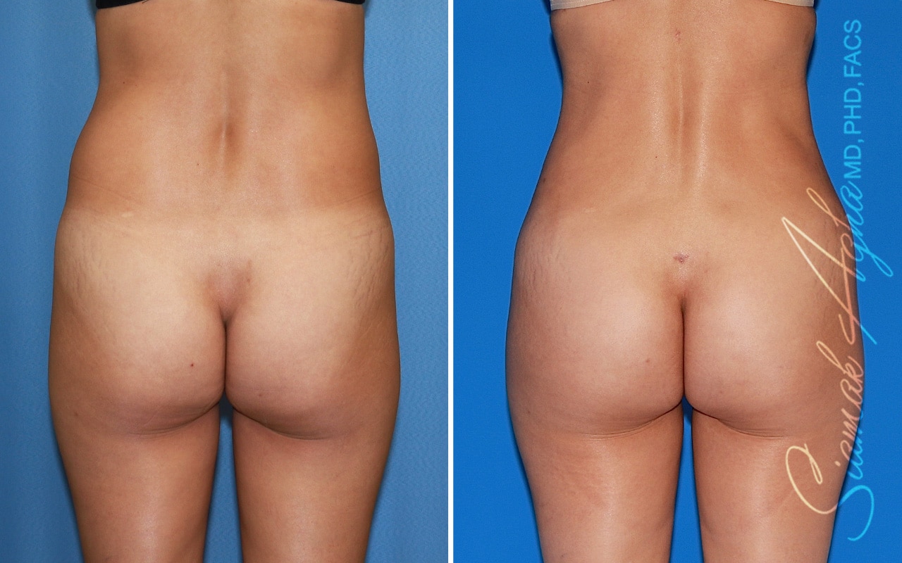 Orange County Brazilian Butt Lift Patient 49 Back Newport Beach, CA