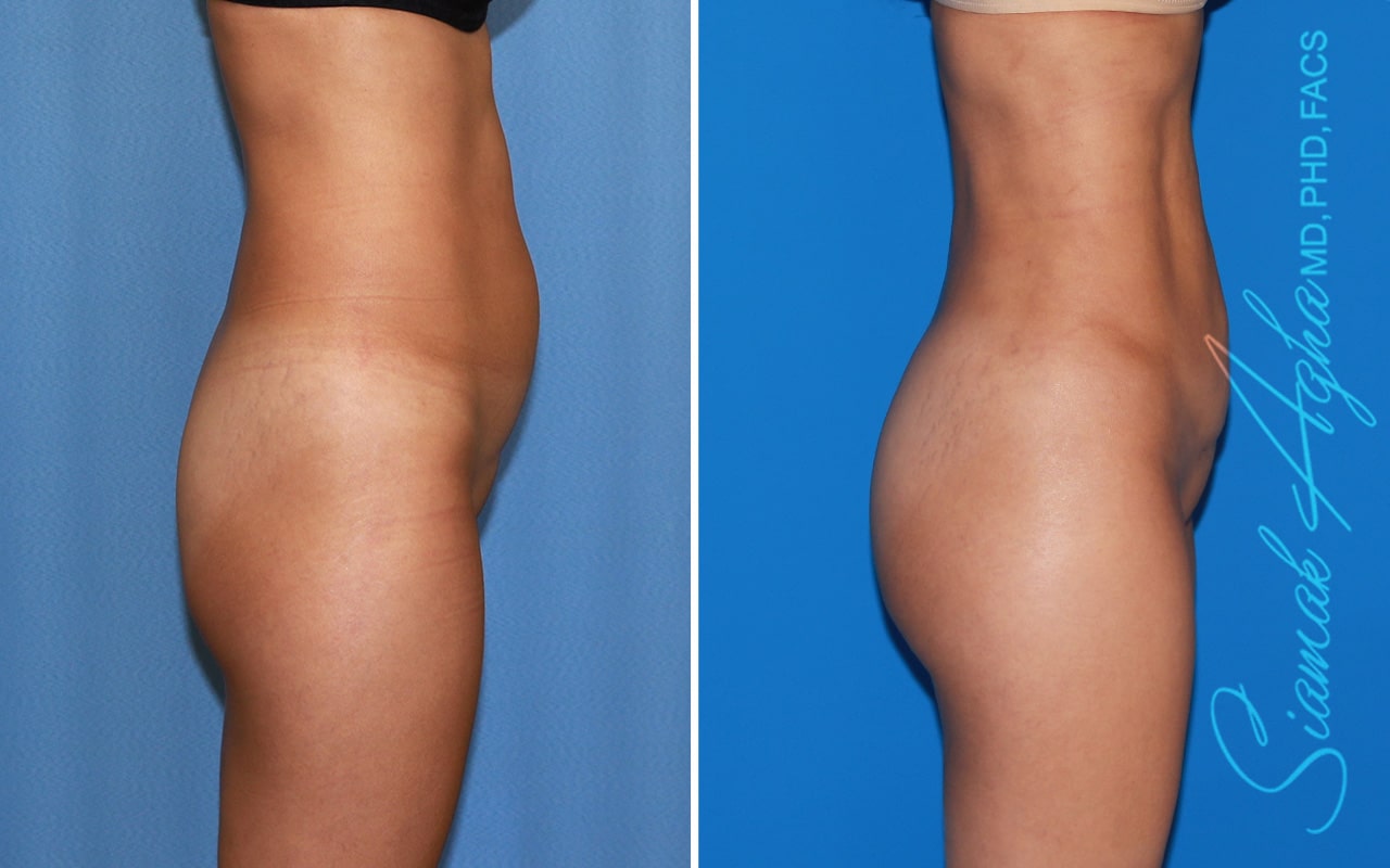 orange county brazilian butt lift patient 49 right Newport Beach, CA