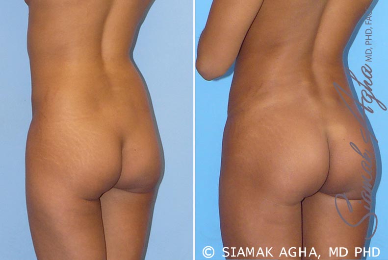 orange county brazilian butt lift patient 5 back left Newport Beach, CA