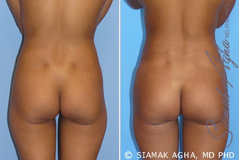 orange county brazilian butt lift patient 5 back Newport Beach, CA