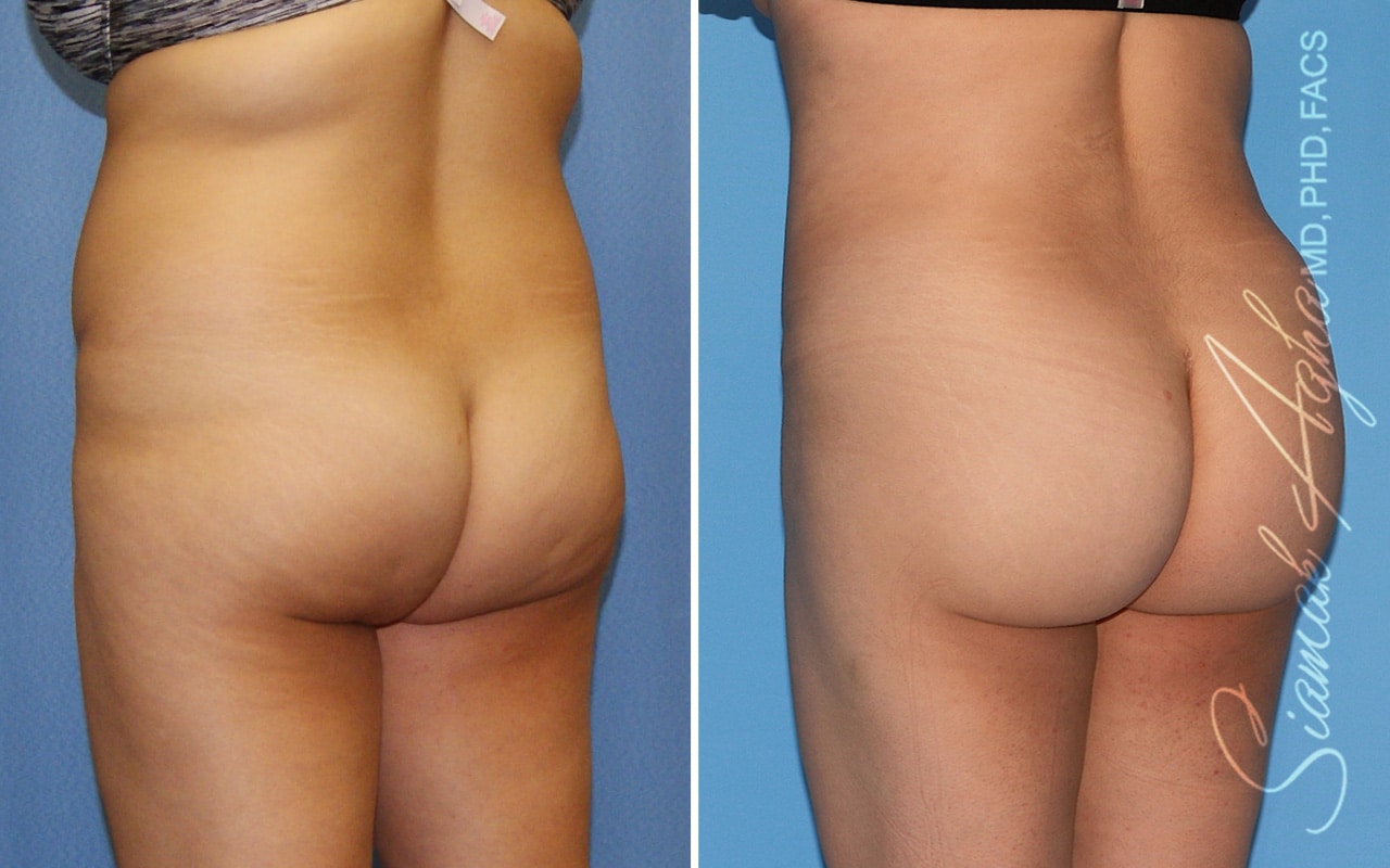 Orange County Brazilian Butt Lift Patient 53 Back Left Newport Beach, CA