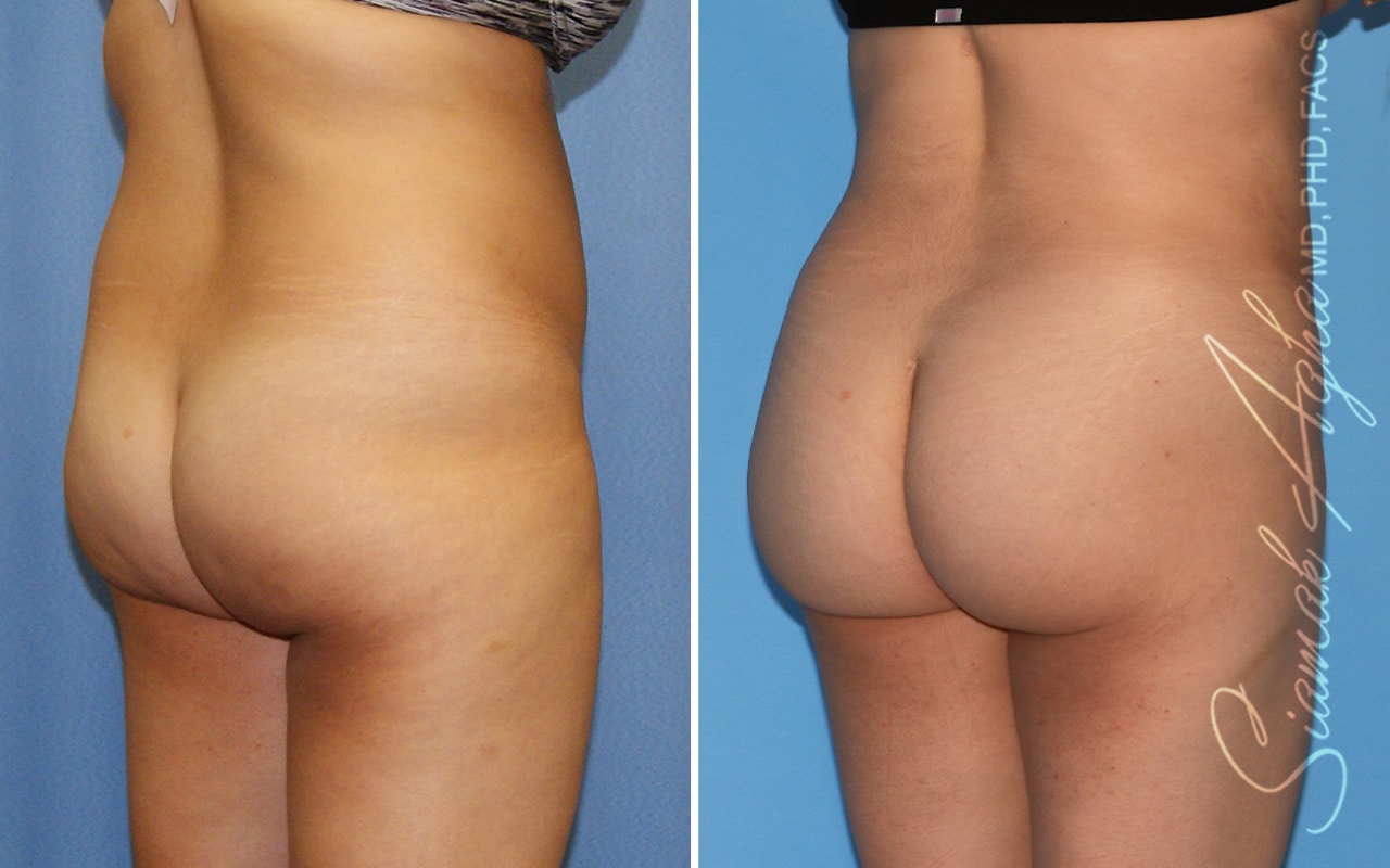 Orange County Brazilian Butt Lift Patient 53 Back Right Newport Beach, CA